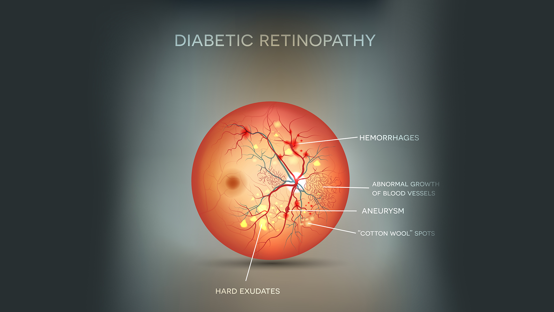 Diabetic Retinopathy, Diabetes & Vision Loss: Key sources - My blog