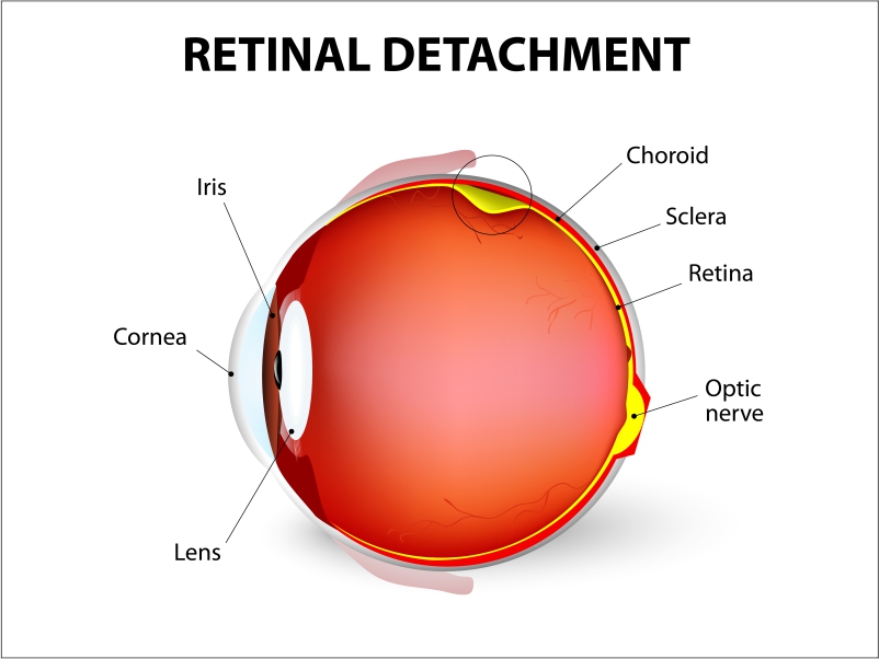 Maxvision_Retinal detachment surgery