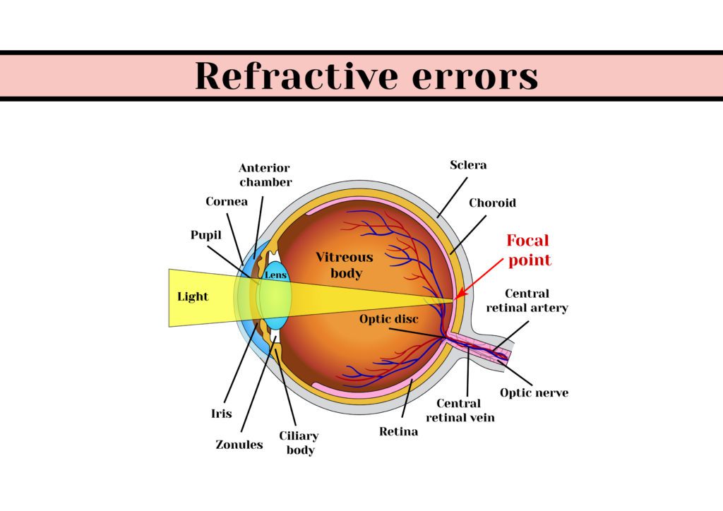 Refractive errors __ Maxivision
