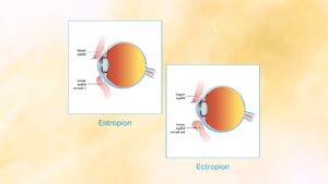 What is Entropion and Ectropion?