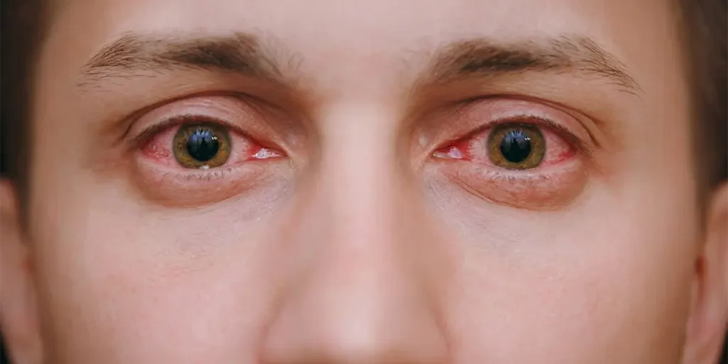 allergic_conjunctivitis