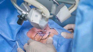 Comparison of SMILE vs. LASIK eye surgery