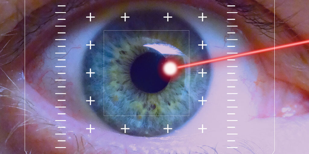 LASIK surgery for astigmatism correction