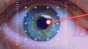 LASIK surgery for astigmatism correction