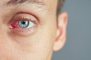 Blepharitis Treatment for Eyelid Inflammation