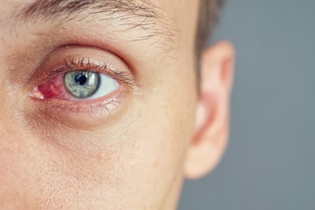 Blepharitis Treatment for Eyelid Inflammation Blepharitis Treatment for Eyelid Inflammation