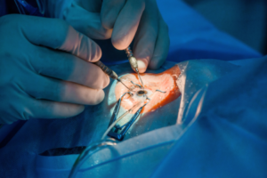 Eye Transplant Surgery