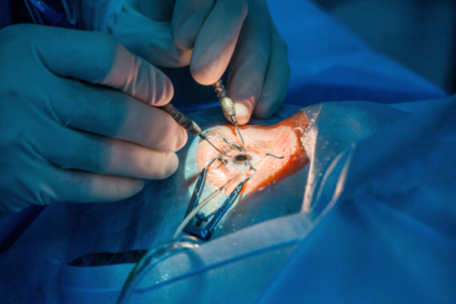 Eye Transplant Surgery Eye Transplant Surgery
