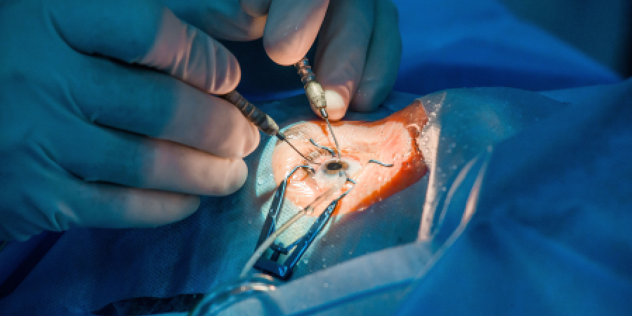 Eye Transplant Surgery Eye Transplant Surgery