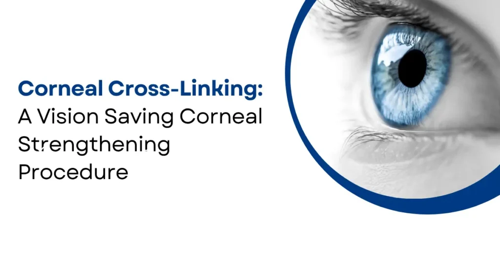Corneal Cross-Linking for Keratoconus