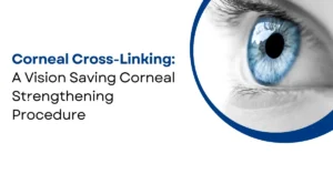 Corneal Cross-Linking for Keratoconus
