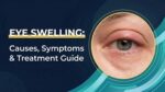 Eye Swelling Causes, Symptoms and Treatment Guide