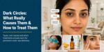 what-causes-dark-circles-under-eyes-types-treatment