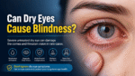 Dry Eyes Cause Blindness
